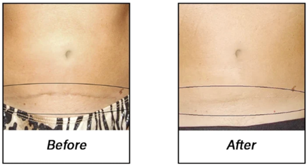 Before and after images of a C-section scar